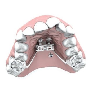 Fixing screw for mini implant in TAD device - set 2 pcs.