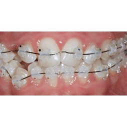 Logic line aesthetic brackets (Micro-filled copolymer)