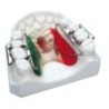 Rapid molar distalizer "First Class"