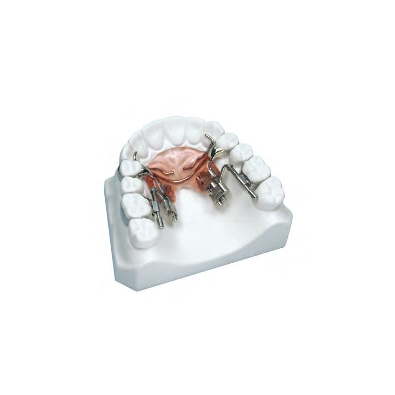 Rapid molar distalizer "Fast Back"