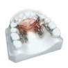 Rapid molar distalizer "Fast Back"