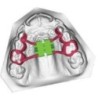 Винт за бърза експанзия подсилен, 4 слота CAD CAM 3D