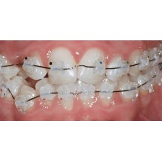 D.B. aesthetic bracket "Logic Line" (sil. copolymer) - single piece