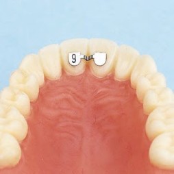 Upper retainer central to central.