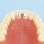Upper retainer central to central