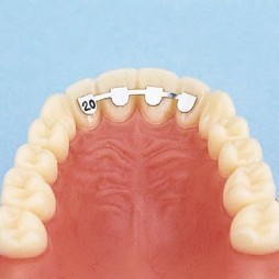 Upper retainer lateral to lateral.