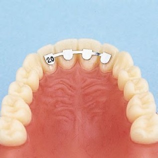 Upper retainer lateral to lateral