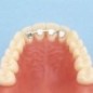 Upper retainer lateral to lateral