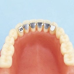Lower cuspid to cuspid retainer for direct bonding.