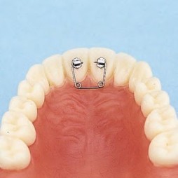 Spring for diastema kit