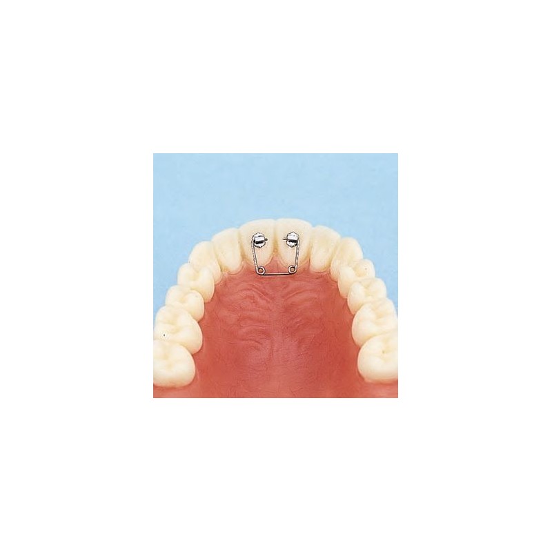 Spring for diastema kit