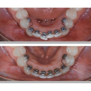 IDEA-L lingual brackets (kit 4/4) - 8 pcs.