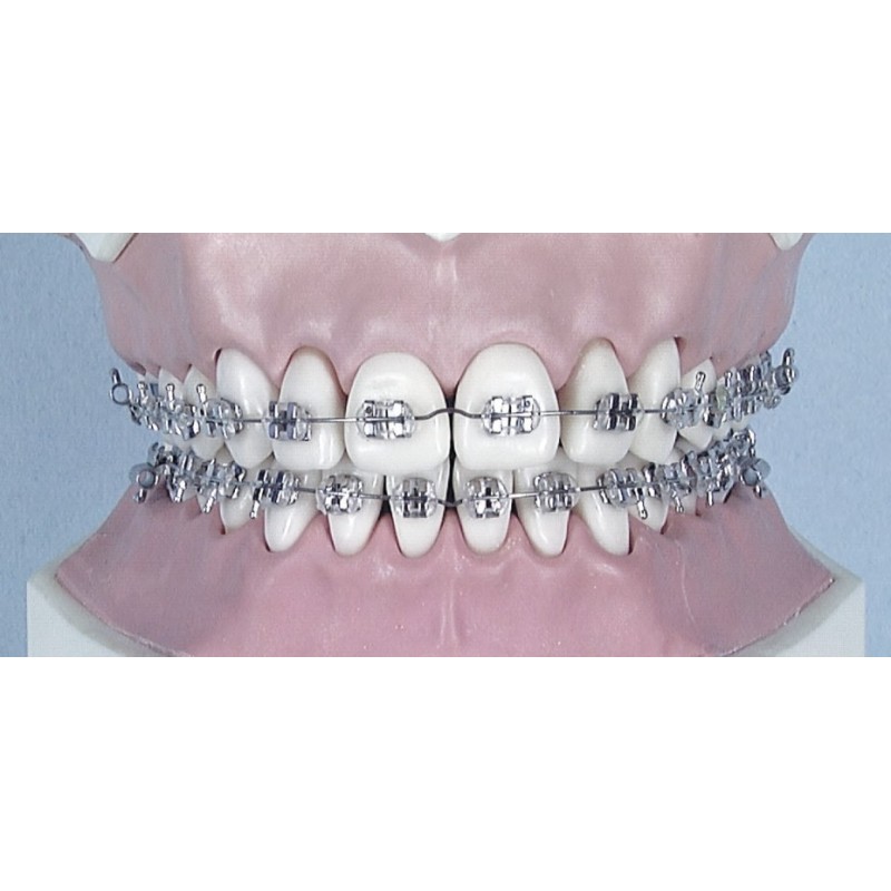 NiTi memoria round archwire with "V" bend for F1000 self-ligating brackets