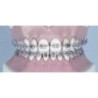 NiTi memoria round archwire with "V" bend for F1000 self-ligating brackets