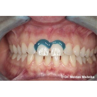 Acrylic light curing gingival barrier. Block out.