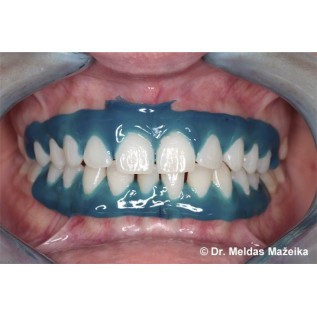 Acrylic light curing gingival barrier. Block out.