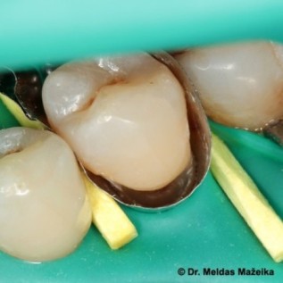 Light curing composite, flowable, nano hybrid.