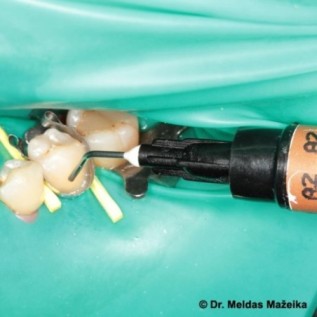 Light curing composite, flowable, nano hybrid.
