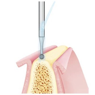 Round bur, bone cutter