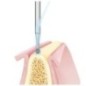 Round bur, bone cutter