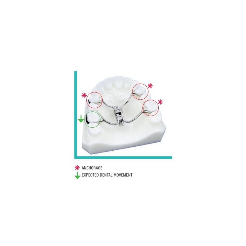 Expander screw for unilateral distalization - 11 mm