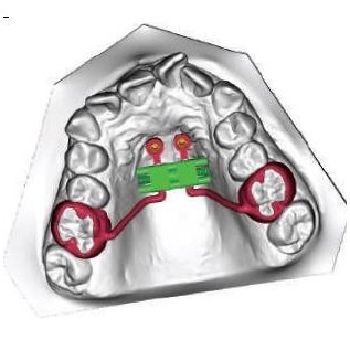 Anatomical expansion screw CAD CAM 3D frame
