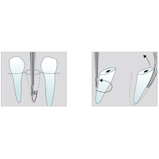 TC surgical turbine bur for peri-implantitis