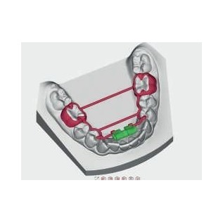 Expansion screw mandibular CAD-CAM 3D